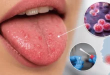 SilverTrend blog post about the SilverTrend blog post about the Chlamydia Bumps on Tongue.