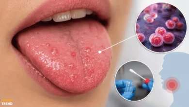 SilverTrend blog post about the SilverTrend blog post about the Chlamydia Bumps on Tongue.