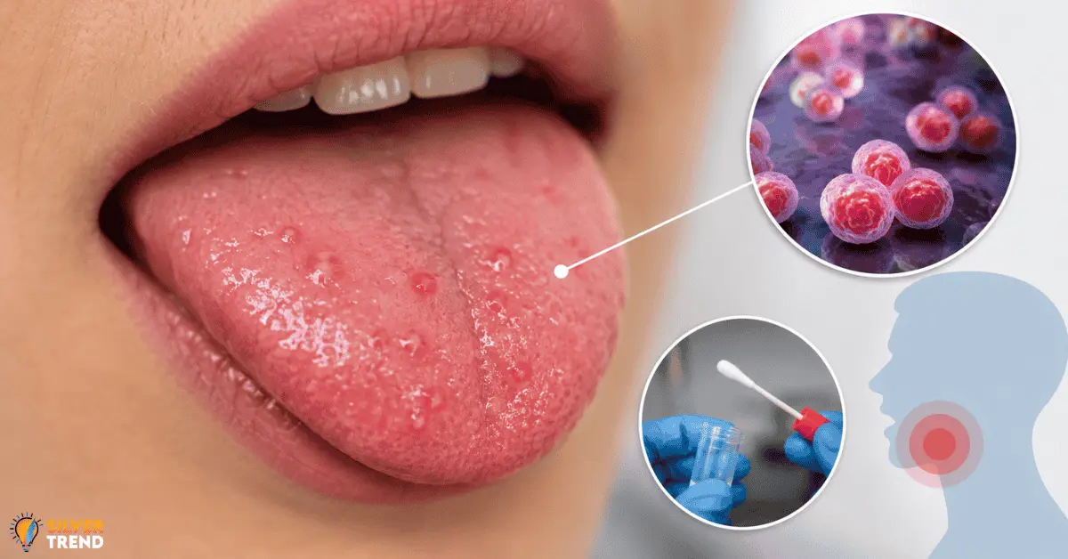 SilverTrend blog post about the SilverTrend blog post about the Chlamydia Bumps on Tongue.
